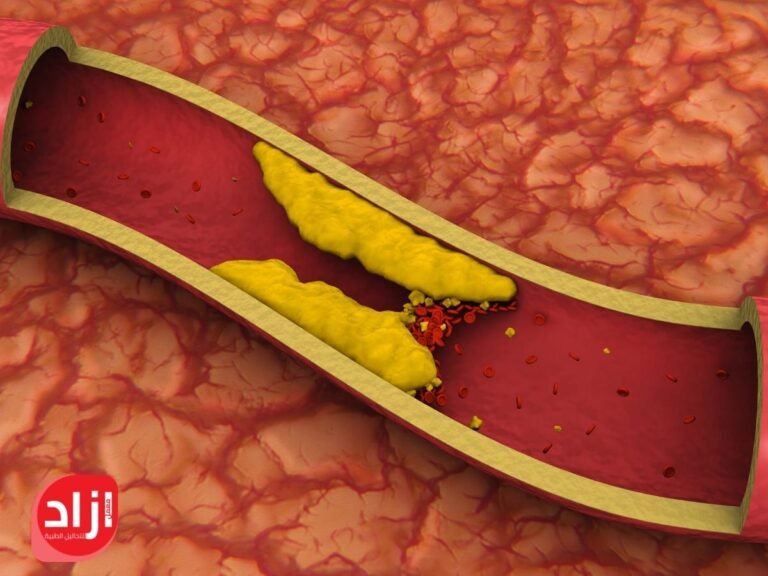 رسم توضيحي ثلاثي الأبعاد يوضح انسداد أحد الشرايين نتيجة جلطة دموية وتأثيره على تدفق الدم